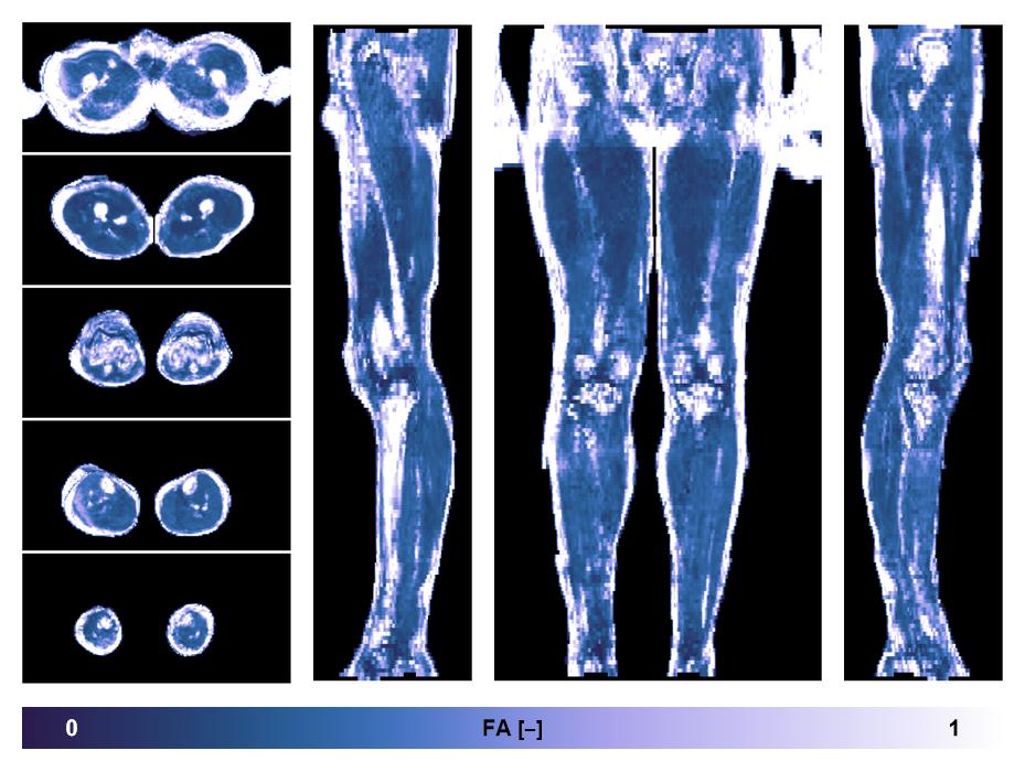 IVIM corrected whole leg muscle fractional anisotropy obtained from diffusion tensor imaging.